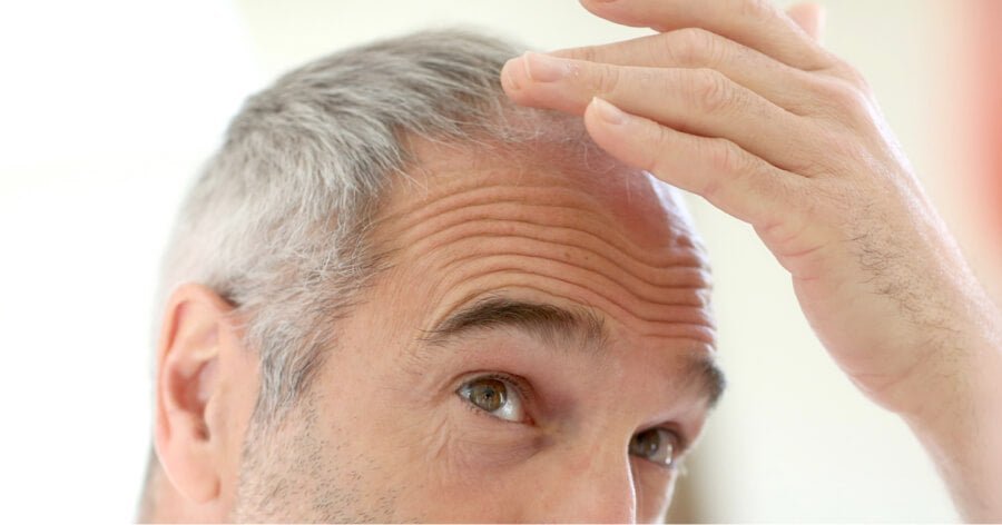 Everything You Need to Know About Androgenic Alopecia