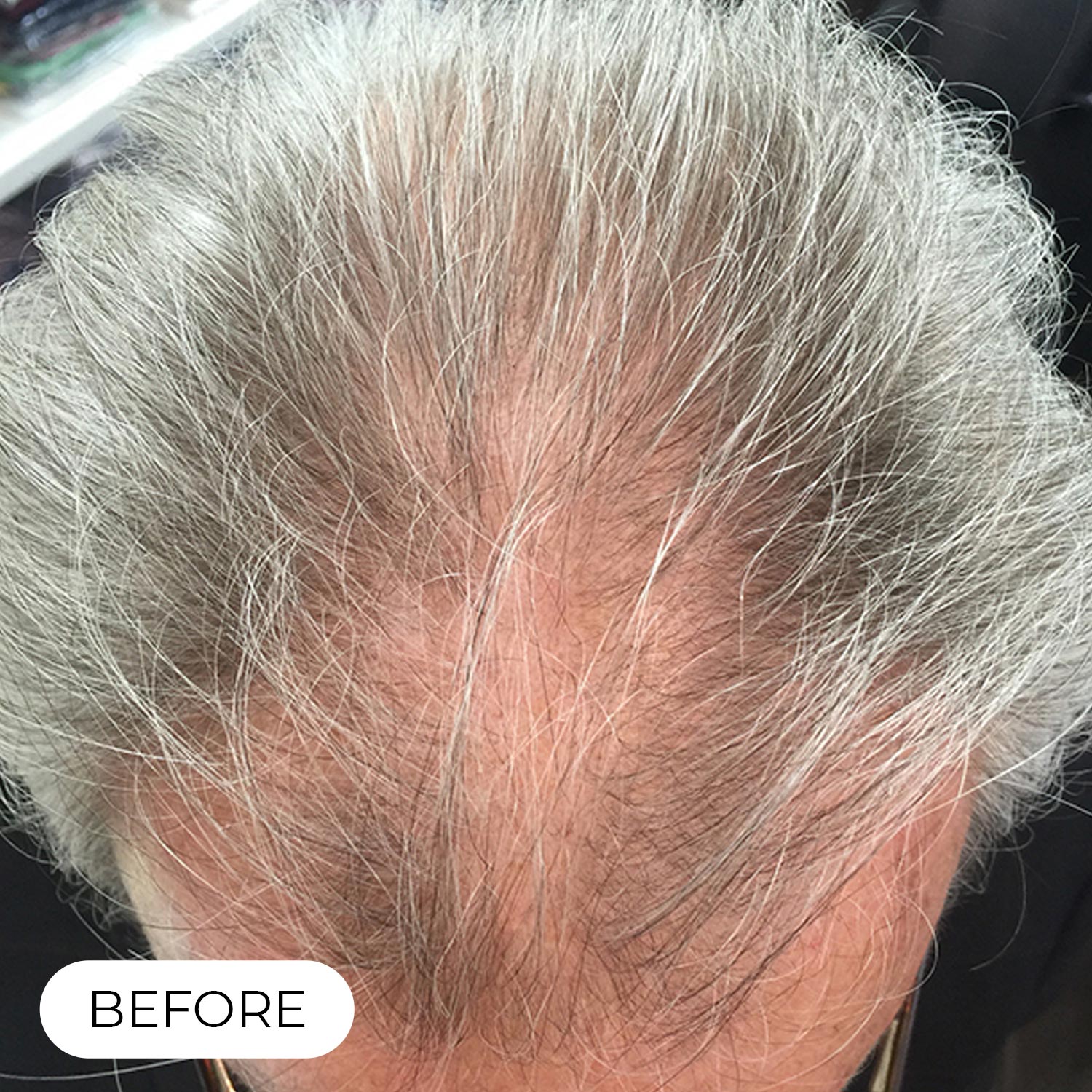 Capillus Pro Laser Cap for Hair Regrowth Achieve Clinically Proven Results