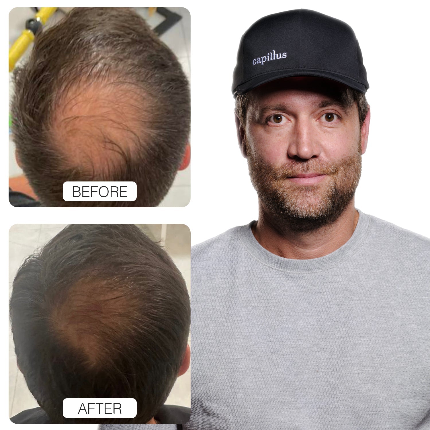 Laser Cap for Hair Growth: Stop the Hair Loss with Capillus Hat - Best Hair  Regrowth Device